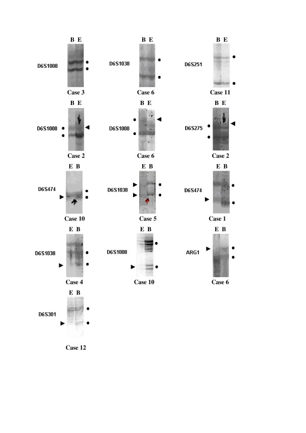 gene alterations in patients with mesothelioma
